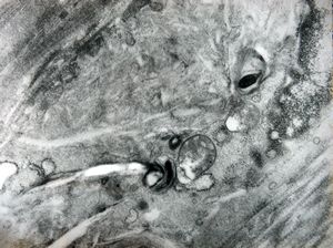 M,3y. | globoid leukodystrophy of Krabbe - n.suralis M,3y. | globoid leukodystrophy of Krabbe - n.suralis